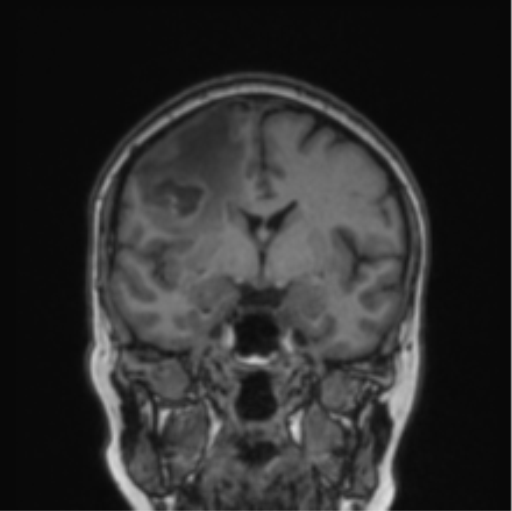 File:Cerebral abscess from pulmonary arteriovenous malformation (Radiopaedia 86275-102291 Coronal T1 52).png