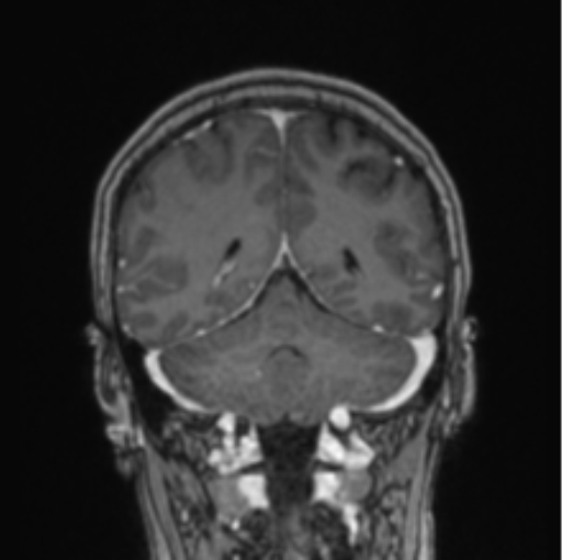 Cerebral abscess from pulmonary arteriovenous malformation (Radiopaedia 86275-102291 L 31).png