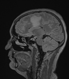 Cerebral abscess from pulmonary arteriovenous malformation (Radiopaedia 86275-102291 Sagittal FLAIR 42).png