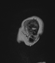 Cerebral abscess from pulmonary arteriovenous malformation (Radiopaedia 86275-102291 Sagittal FLAIR 5).png