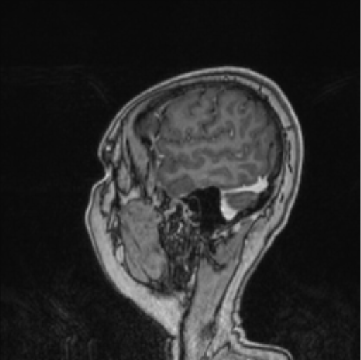 Cerebral abscess from pulmonary arteriovenous malformation (Radiopaedia 86275-102291 Sagittal T1 C+ 14).png