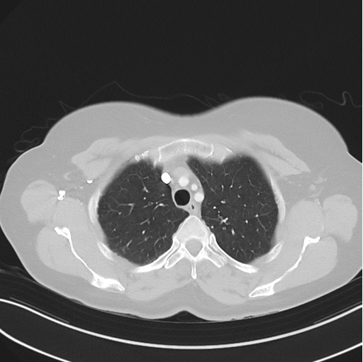 Cerebral abscess from pulmonary arteriovenous malformation (Radiopaedia 86275-102292 Axial lung window 16).png