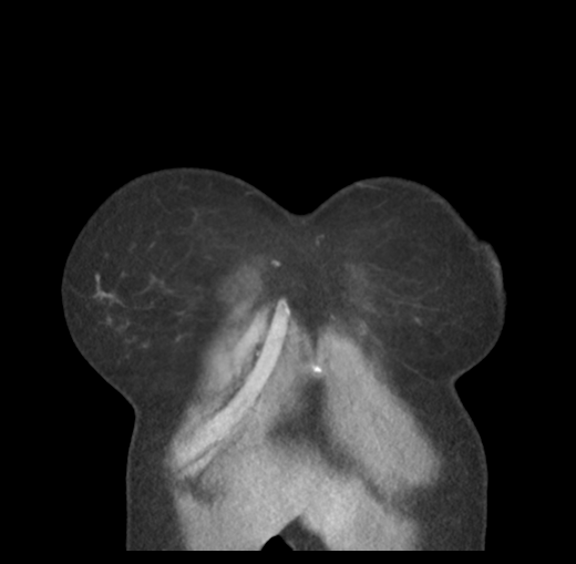 Cerebral abscess from pulmonary arteriovenous malformation (Radiopaedia 86275-102292 C 8).png