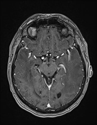 Cerebral amyloid angiopathy-related inflammation (Radiopaedia 58270-65377 Axial T1 C+ fat sat 60).jpg