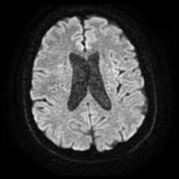 File:Cerebral amyloid angiopathy (Radiopaedia 28698-28978 Axial DWI 18).jpg