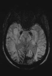 File:Cerebral amyloid angiopathy (Radiopaedia 29129-29518 Axial SWI MIP 14).jpg