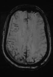 File:Cerebral amyloid angiopathy (Radiopaedia 29129-29518 Axial SWI MPR 24).jpg