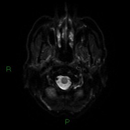 Cerebral amyloid angiopathy (Radiopaedia 77506-89664 Axial DWI 31).jpg