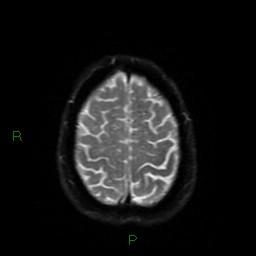 File:Cerebral amyloid angiopathy (Radiopaedia 77506-89664 Axial DWI 52).jpg