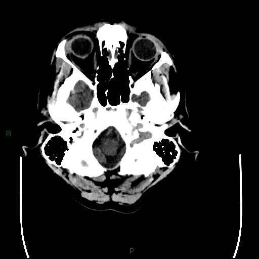 Cerebral amyloid angiopathy (Radiopaedia 77506-89665 Axial non-contrast 14).jpg