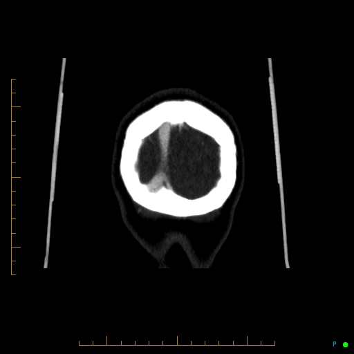 Cerebral arteriovenous malformation (AVM) (Radiopaedia 78162-90706 Coronal CTA 10).jpg