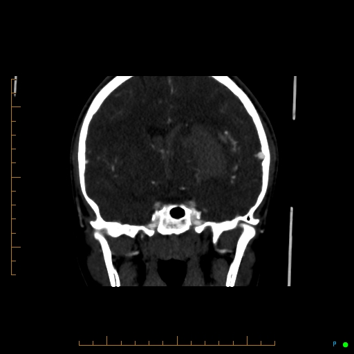 Cerebral arteriovenous malformation (AVM) (Radiopaedia 78162-90706 Coronal CTA 56).jpg