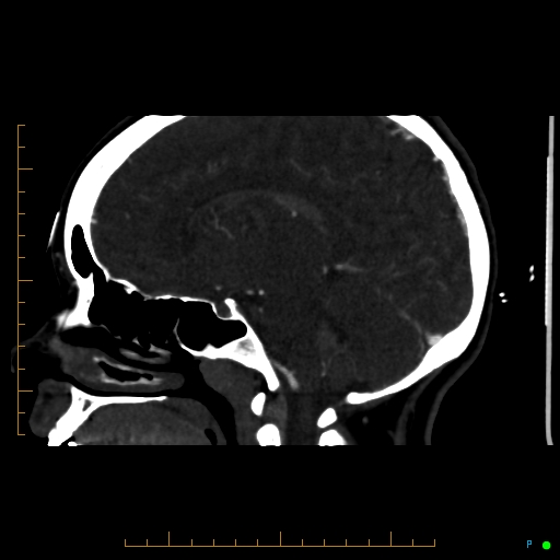 Cerebral arteriovenous malformation (AVM) (Radiopaedia 78162-90706 Sagittal CTA 38).jpg