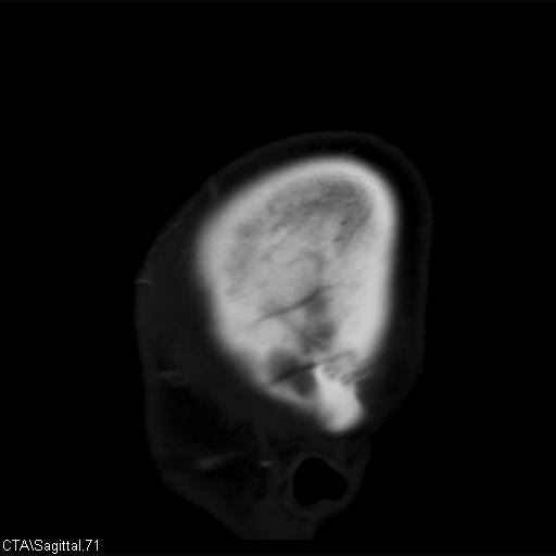 File:Cerebral arteriovenous malformation (Radiopaedia 28518-28759 D 68).jpg