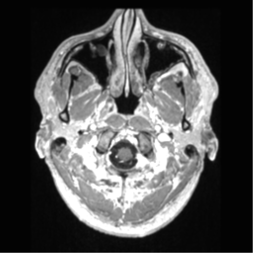 File:Cerebral arteriovenous malformation (Radiopaedia 39259-41506 AX T1 MPR C+ 3).png