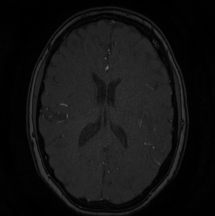Cerebral arteriovenous malformation (Radiopaedia 74411-85654 Axial MRA 92).jpg