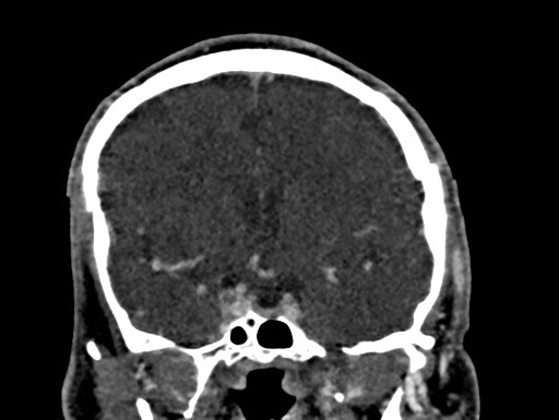 File:Cerebral arteriovenous malformation (Radiopaedia 78188-90746 Coronal C+ delayed 46).jpg