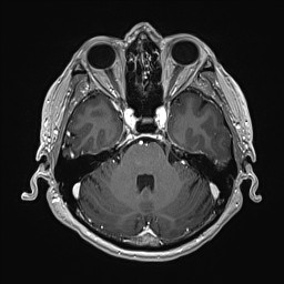 File:Cerebral arteriovenous malformation (Radiopaedia 84015-99245 Axial T1 C+ 52).jpg