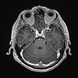 File:Cerebral arteriovenous malformation (Radiopaedia 84015-99245 Axial T1 C+ 57).jpg