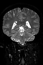 Cerebral arteriovenous malformation at posterior body of corpus callosum (Radiopaedia 74111-84925 Coronal T2 116).jpg