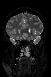 Cerebral arteriovenous malformation at posterior body of corpus callosum (Radiopaedia 74111-84925 Coronal T2 47).jpg
