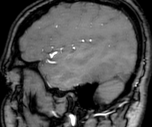 Cerebral arteriovenous malformation at posterior body of corpus callosum (Radiopaedia 74111-84925 J 335).jpg