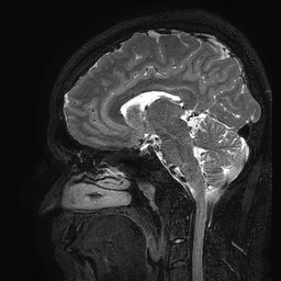 Cerebral arteriovenous malformation at posterior body of corpus callosum (Radiopaedia 74111-84925 Sagittal T2 58).jpg