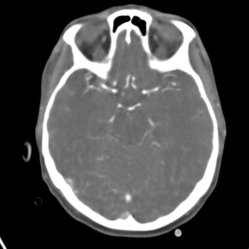Cerebral arteriovenous malformation with hemorrhage (Radiopaedia 28773-29073 A 34).jpg