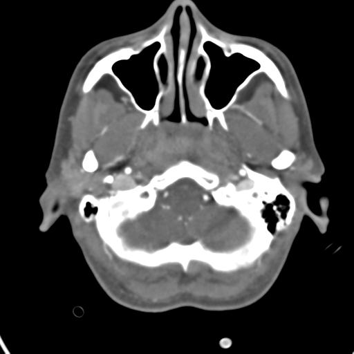 Cerebral arteriovenous malformation with hemorrhage (Radiopaedia 28773-29073 A 47).jpg