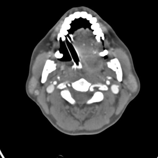 Cerebral arteriovenous malformation with hemorrhage (Radiopaedia 28773-29073 A 60).jpg