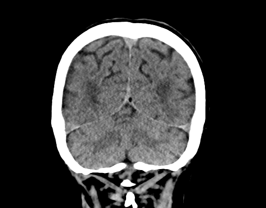 File:Cerebral arteriovenous malformation with lobar hemorrhage (Radiopaedia 44725-48510 Coronal non-contrast 38).png