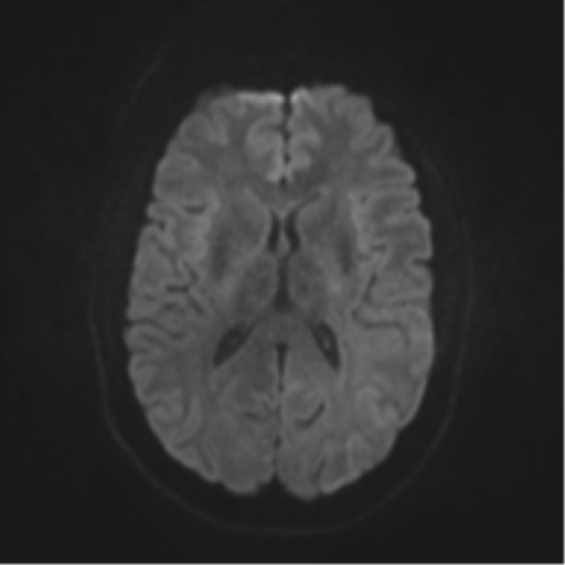 File:Cerebral cavernoma and development venous anomaly (Radiopaedia 37603-39482 Axial DWI 36).png