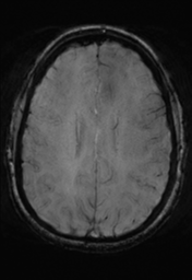 File:Cerebral cavernoma and development venous anomaly (Radiopaedia 37603-39482 Axial SWI 26).png