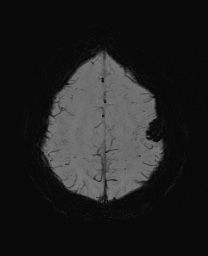 Cerebral cavernous venous malformation (Radiopaedia 70008-80021 Axial SWI 55).jpg