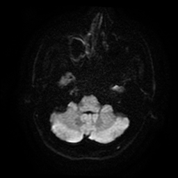 File:Cerebral cavernous venous malformation (Zabramski type II) (Radiopaedia 85511-101198 Axial DWI 41).jpg