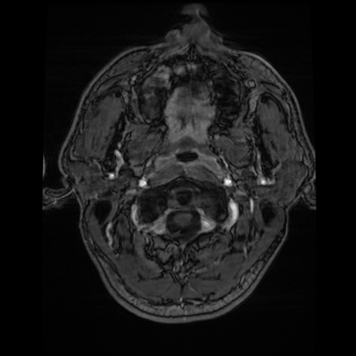 Cerebral cavernous venous malformation (Zabramski type II) (Radiopaedia 85511-101198 Axial T1 C+ fat sat 81).jpg