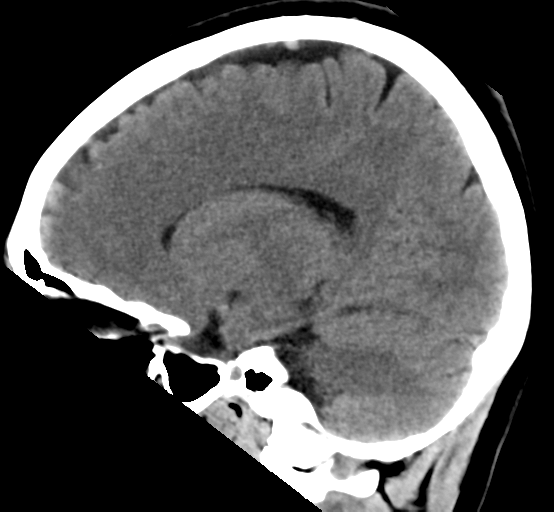 File:Cerebral cavernous venous malformations (Radiopaedia 48117-52945 C 14).png