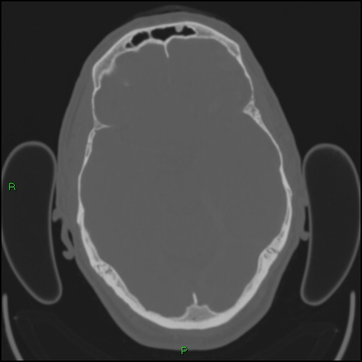 Cerebral contusions (Radiopaedia 33868-35039 Axial bone window 77).jpg