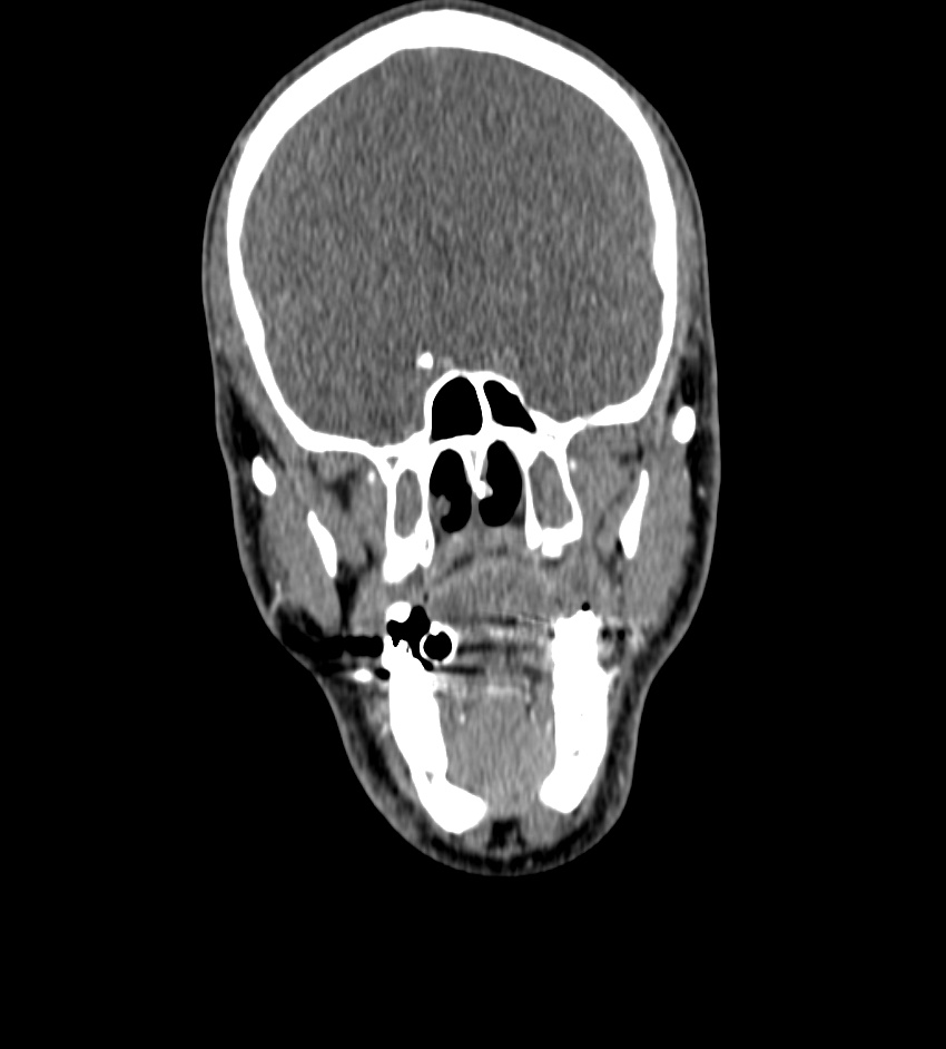 Cerebral edema in an overdose patient (Radiopaedia 72005-82539 B 1).jpg