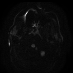 Cerebral embolic infarcts (embolic shower) (Radiopaedia 49837-55108 Axial DWI 95).jpg