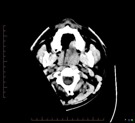 Cerebral fat embolism (Radiopaedia 85521-101220 Axial non-contrast 2).jpg