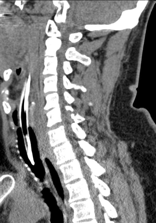 Cerebral hemorrhagic contusions and cervical spine fractures (Radiopaedia 32865-33841 G 53).jpg