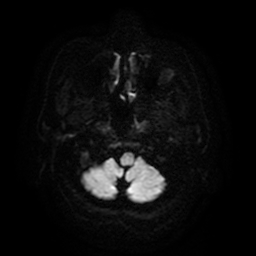 Cerebral metastases - melanoma (Radiopaedia 80972-94522 Axial DWI 37).jpg