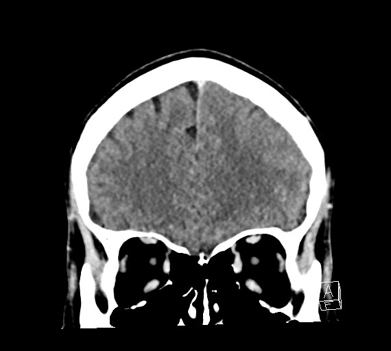 Cerebral metastases - testicular choriocarcinoma (Radiopaedia 84486-99855 D 16).jpg