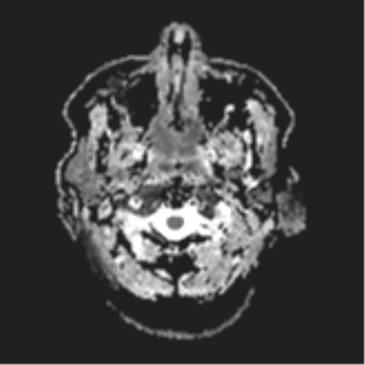 File:Cerebral metastases mimicking abscesses (Radiopaedia 45841-50131 Axial ADC 2).png