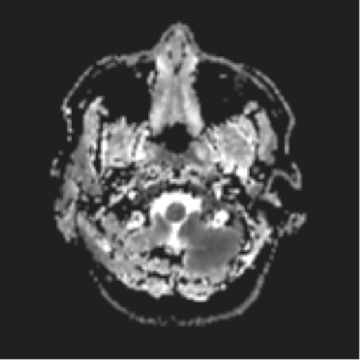 File:Cerebral metastases mimicking abscesses (Radiopaedia 45841-50131 Axial ADC 4).png