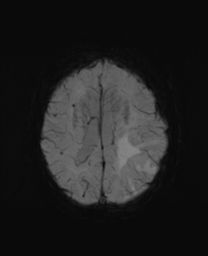 File:Cerebral metastasis (Radiopaedia 46744-51248 Axial SWI 20).png
