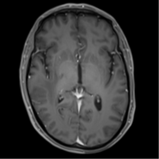 File:Cerebral metastasis - melanoma (Radiopaedia 54718-60954 Axial T1 C+ fat sat 26).png
