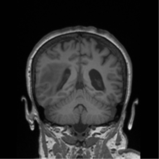 Cerebral metastasis to basal ganglia (Radiopaedia 81568-95413 Coronal T1 11).png