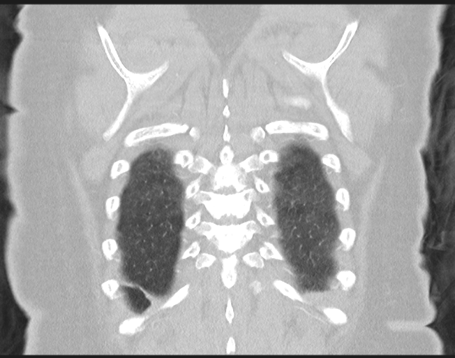 File:Cerebral metastasis to basal ganglia (Radiopaedia 81568-95414 Coronal lung window 73).png